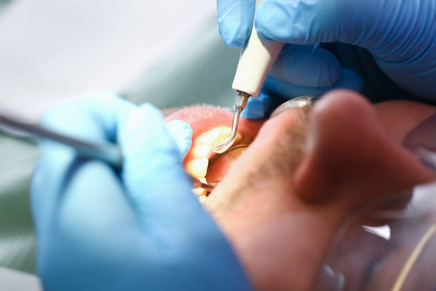 Best Emergency Root Canal Therapy in Ashville, OH